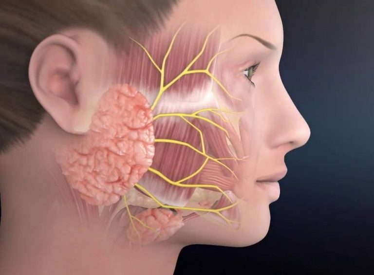 استئصال الغدة النكافية في ايران مع د سعيدي أفضل خبرة ونتيجة وتكلفة