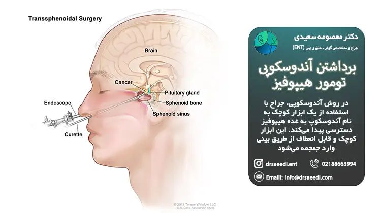 برداشتن آندوسکوپی تومور هیپوفیز