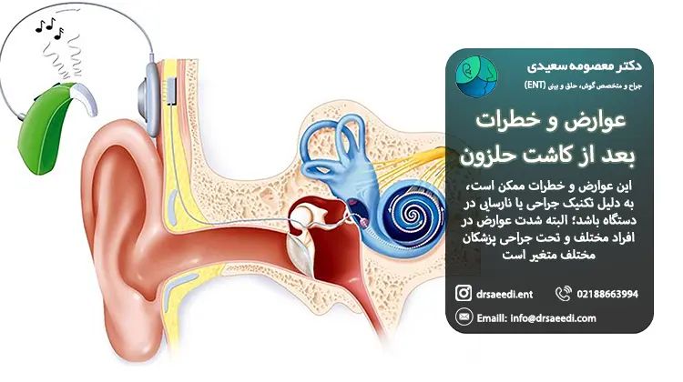 عوارض بعد از کاشت حلزون