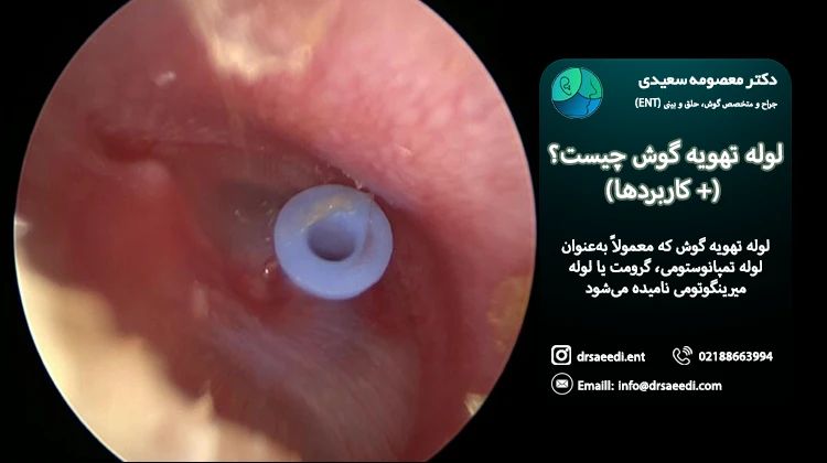 لوله تهویه گوش