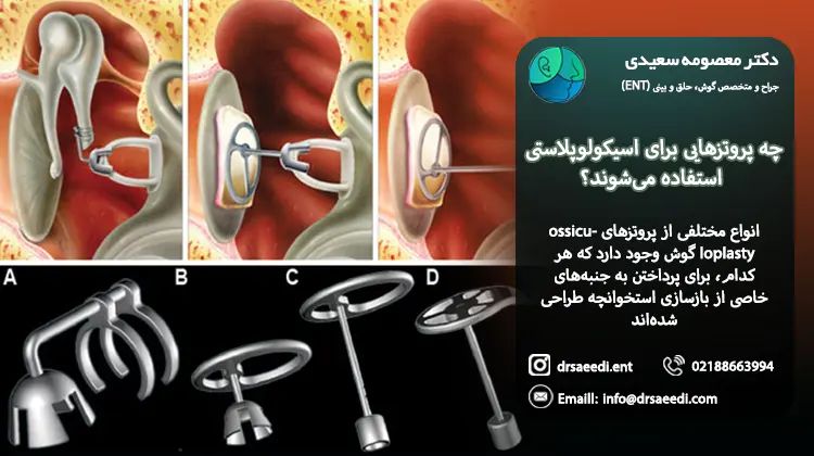 انواع پروتزهای اسیکولوپلاستی