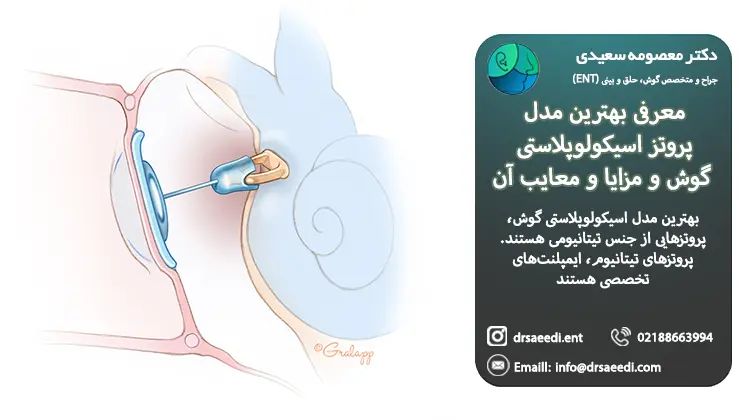 بهترین مدل پروتزهای اسیکولوپلاستی