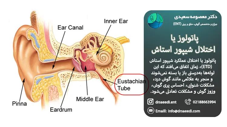 اختلال شیپور استاش