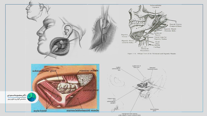 برداشتن تومورهای پارافارنژال