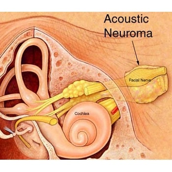 acoustic neuroma timor surgery in Iran