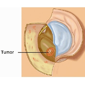 ear tumor removal surgery