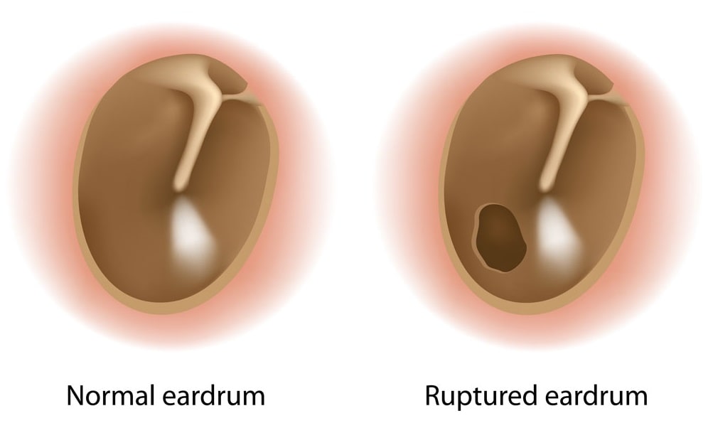 Tympanoplasty In Iran With Dr Saeedi Ent Surgeon In Tehran