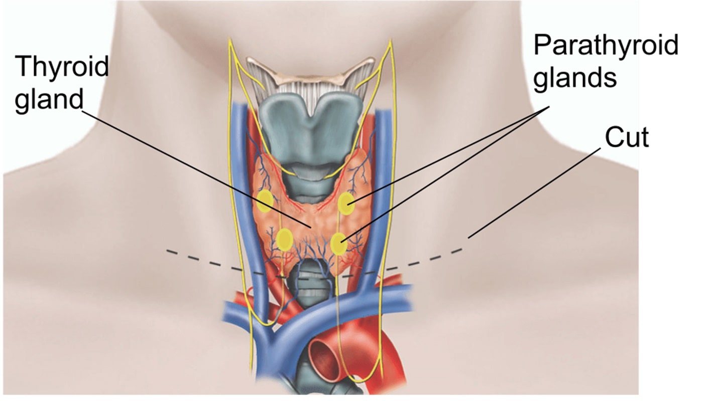 Щитовидная железа и желчный пузырь. Операции на щитовидной железе тиреоидэктомия. Щитовидная железа анатомия. Тиреоидэктомия Оперативная хирургия. Экстрафасциальная тиреоидэктомия.