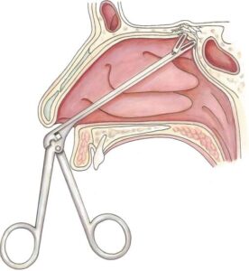 Endoscopic repair of CSF leak from the nose in Iran with Dr. Saeedi