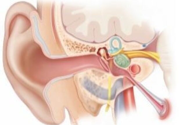 tympanomastoidectomy with ocr