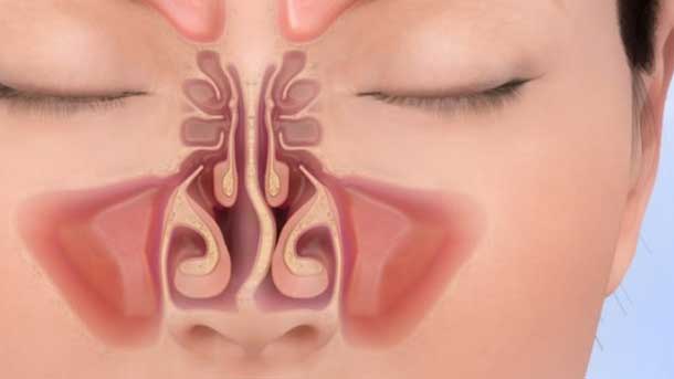 Septoplasty Surgeries