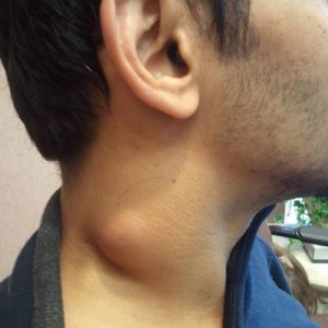 Neck mass biopsy in Iran with Dr. Saeedi | ENT Surgeon