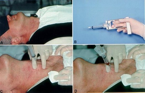 neck mass biopsy in Iran with Dr. Saeedi