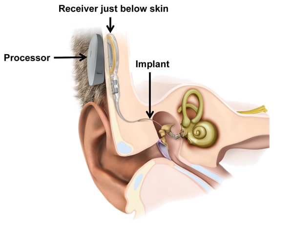 middle ear implant in Iran with Dr. Saeedi