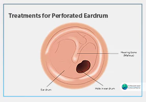 Treatments for Perforated Eardrum feature Treatments for Perforated Eardrum feature